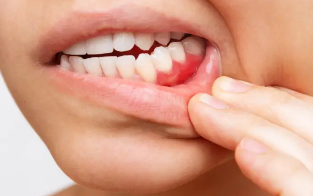 What is Periodontics? Treating Gum Disease