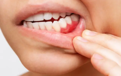 What is Periodontics? Treating Gum Disease