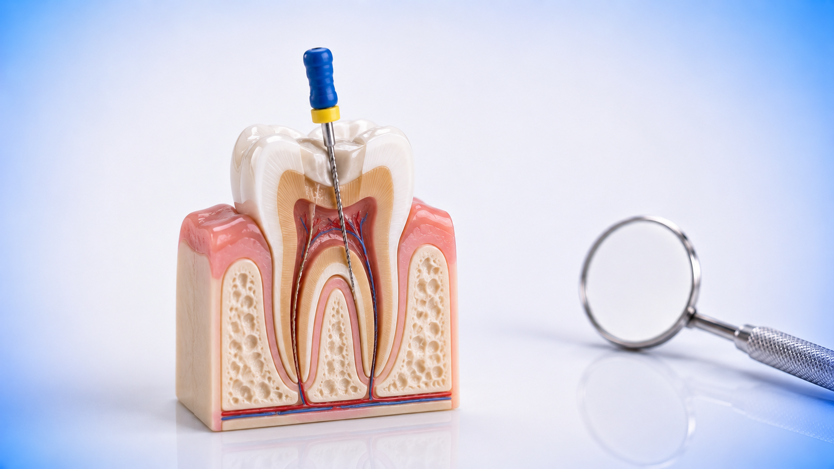 Root Canal