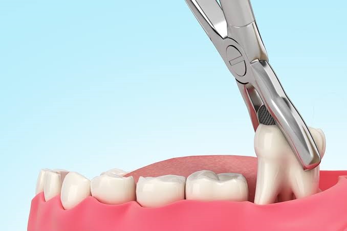 Extractions